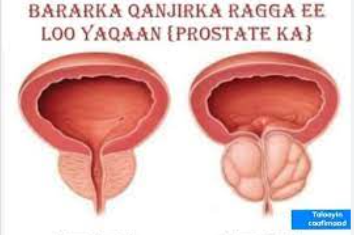 Warbixin ku Saabasan Saameynta Caafimaad daro ka dhasha Cudurada ku dhaca Qanjirka Raga.